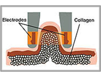 Cuerpo infrarrojo de la cavitación de las celulitis que forma el equipo con el rodillo del vacío bipolar del RF/del LPG