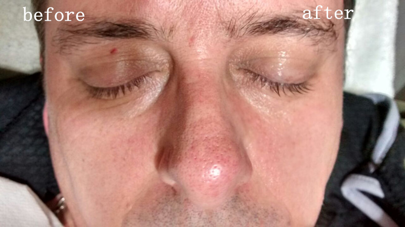 Retiro de alta frecuencia del doblez nasolabial del aumento de Malar de la máquina de cara