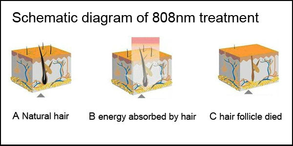 laser caliente de la armonÃ­a de Alma del retiro del pelo del diodo 808nm